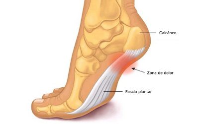 Fascitis plantar