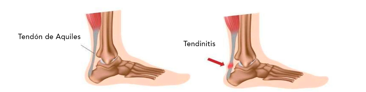 Tendinitis aquilea
