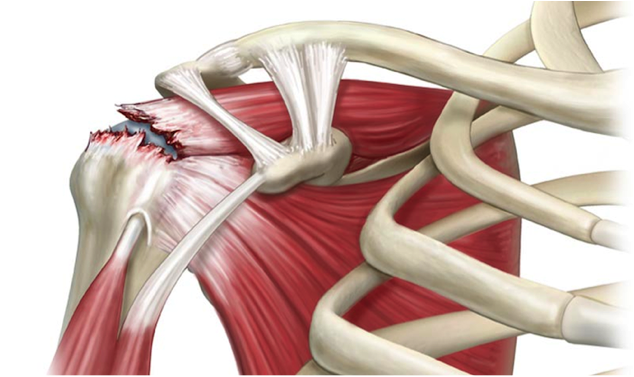 Tendinitis De Manguito De Rotadores Del Hombro Enrique Garc a Ballesteros Tendinitis De Manguito De Rotadores Del Hombro Enrique Garc a Ballesteros