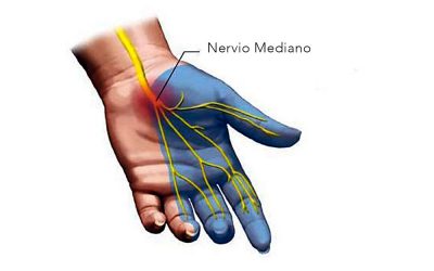 Síndrome del túnel metacarpiano