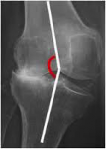 Radiografía esguince de rodilla