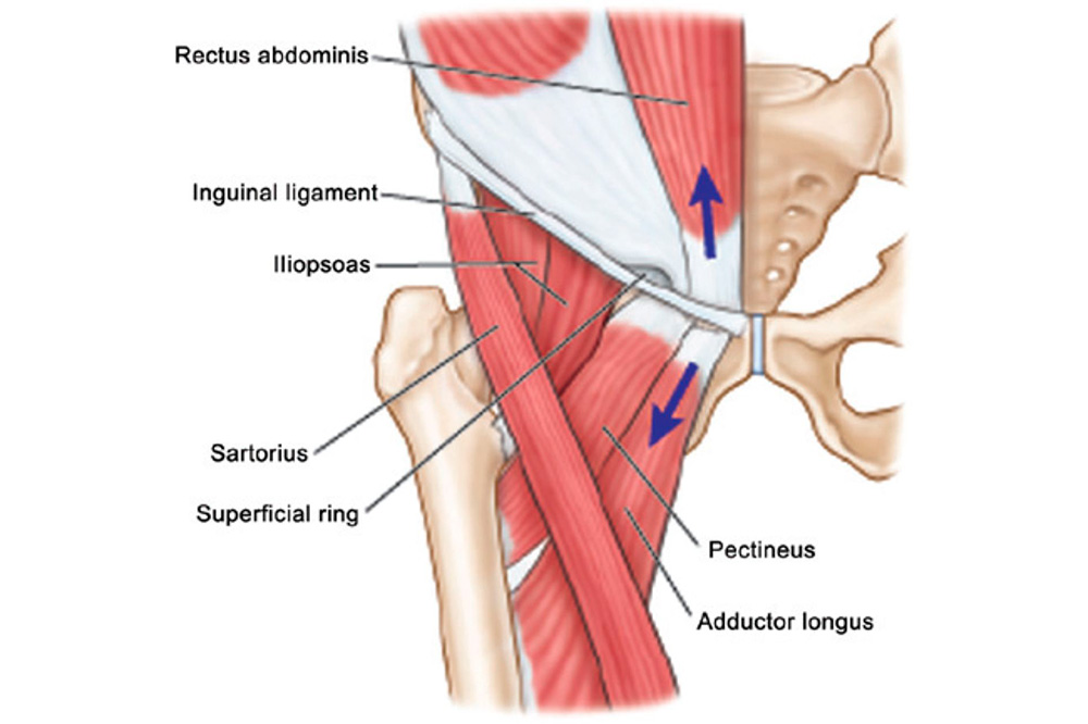 Osteopatía del pubis