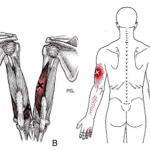 Epicondilitis vs puntos gatillo del tríceps