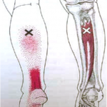 Tendinitis de tendón de Aquiles vs punto gatillo de tibial posterior